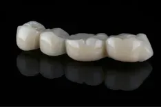 Bridge Tooth Prices.webp