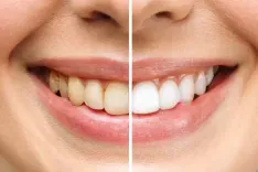 What Causes Tooth Discoloration and How Can It Be Treated en